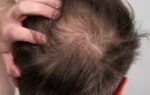 are hair transplants safe