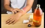 removing mole with apple cider vinegar