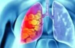 sharp rise in lung cancer among women
